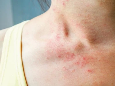 Nổi Ban Đỏ Ngứa Nhưng Không Sốt Ở Người Lớn: Dấu Hiệu, Nguyên Nhân và Cách Xử Lý