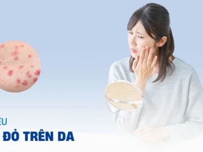 Nổi chấm đỏ trên da: Nguyên nhân, dấu hiệu và cách điều trị hiệu quả 2026