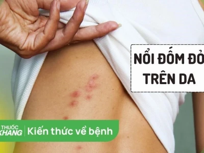 Nổi đốm đỏ trên da: Nguyên nhân, triệu chứng và cách xử lý hiệu quả
