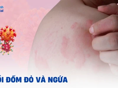 Nổi đốm đỏ trên da và ngứa: Nguyên nhân, triệu chứng và cách xử lý