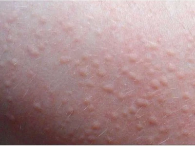 Nổi Hạt Ngứa Khắp Người: Nguyên Nhân, Cách Xử Lý và Phòng Ngừa Hiệu Quả