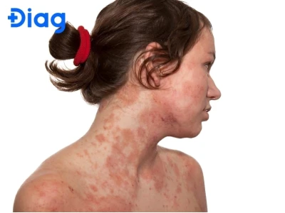 Nổi hột đỏ ngứa khắp người là dấu hiệu bệnh gì và cách xử lý