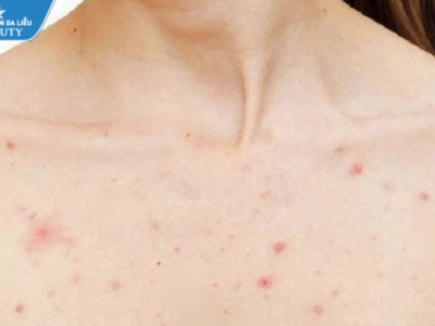 Nổi Mẩn Đỏ Không Ngứa Như Muỗi Đốt: Nguyên Nhân Và Cách Xử Lý Hiệu Quả