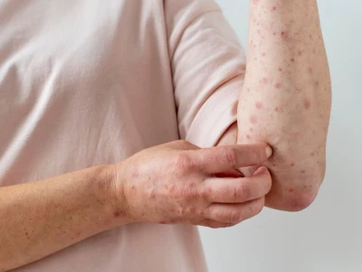Nổi Mẩn Đỏ Ngứa Khắp Người Là Bệnh Gì? Nguyên Nhân và Cách Xử Lý