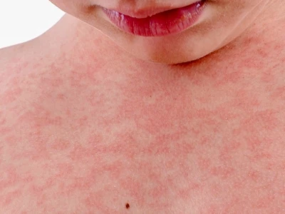 Nổi mẩn đỏ ngứa khắp người: Nguyên nhân và cách xử lý hiệu quả