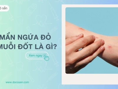 Nổi mẩn đỏ ngứa như muỗi đốt: Nguyên nhân, triệu chứng và cách xử lý hiệu quả