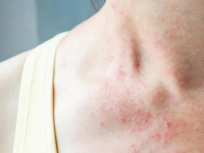 Nổi Mẩn Đỏ Ở Cổ Người Lớn: Nguyên Nhân, Dấu Hiệu Và Cách Xử Lý