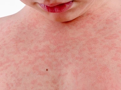Nổi mẩn đỏ và ngứa khắp người: Nguyên nhân và cách xử lý hiệu quả
