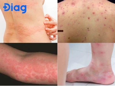 Nổi mẩn ngứa khắp người là bệnh gì? Nguyên nhân và cách xử lý hiệu quả