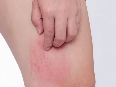 Nổi mẩn ngứa thành mảng khắp người: Nguyên nhân, dấu hiệu và cách xử lý hiệu quả