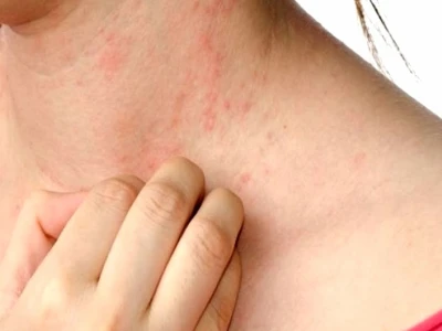 Nổi Mề Đay Mẩn Ngứa: Nguyên Nhân, Triệu Chứng và Cách Điều Trị Hiệu Quả