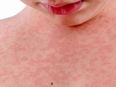 Nổi mụn đỏ ngứa khắp người: Nguyên nhân, cách điều trị và phòng ngừa hiệu quả