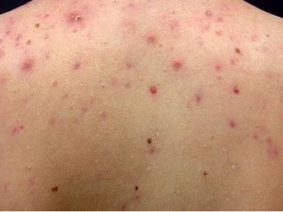 Nổi mụn đỏ ở người: Nguyên nhân, dấu hiệu và cách điều trị hiệu quả