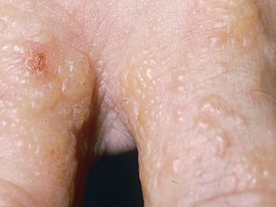 Nổi mụn nước khắp người không ngứa: Nguyên nhân và cách xử lý