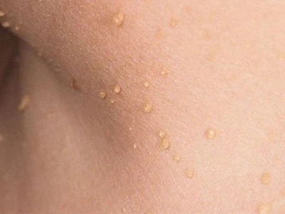 Nổi mụn thịt khắp người: Nguyên nhân, triệu chứng và cách điều trị hiệu quả