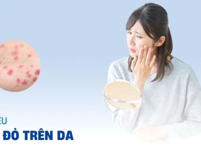 Nổi nhiều nốt đỏ trên người: Nguyên nhân và cách xử lý hiệu quả