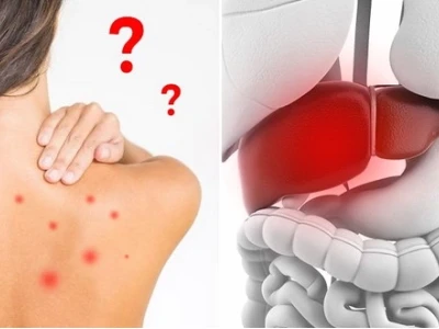 Nóng Gan Nổi Mụn Khắp Người: Nguyên Nhân, Cách Nhận Biết và Giải Pháp Hiệu Quả