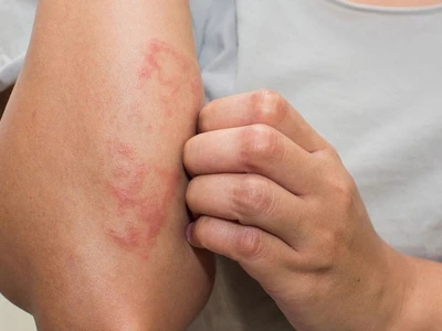 Nóng trong người nổi mụn nước: Nguyên nhân và cách xử lý hiệu quả