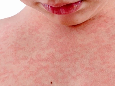Phân biệt và cách xử lý phát ban đỏ ngứa khắp người an toàn