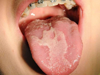 Phân biệt Viêm lưỡi bản đồ và Ung thư lưỡi: Khi nào cần lo lắng?