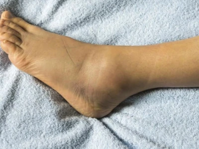 Phù chân ở người già: Hiểu đúng nguy cơ và cách xử lý hiệu quả
