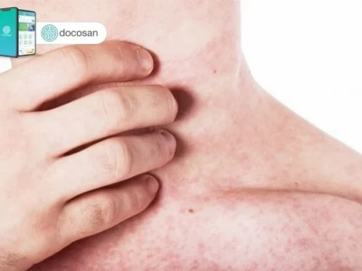 Rôm sảy ở người lớn: Nguyên nhân, triệu chứng và cách điều trị hiệu quả