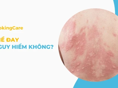 Sốt Nổi Mề Đay Ở Người Lớn: Nguyên Nhân, Triệu Chứng Và Cách Xử Lý
