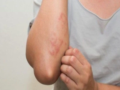 Sốt phát ban ở người lớn có ngứa không và cách xử lý hiệu quả