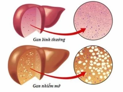 Thực đơn hàng ngày cho người bị gan nhiễm mỡ: Gợi ý từ chuyên gia