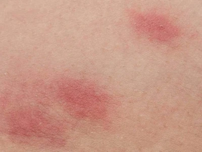 Thuốc Trị Hăm Mông Người Lớn: Nguyên Nhân, Cách Phòng Ngừa và Lựa Chọn Hiệu Quả