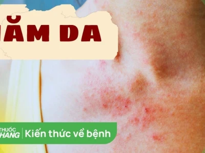 Thuốc trị hăm nách người lớn: Nguyên nhân, cách điều trị và phòng ngừa hiệu quả