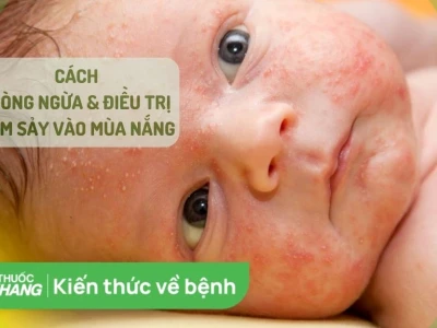 Thuốc trị rôm sảy ở người lớn: Nguyên nhân, dấu hiệu và cách xử lý hiệu quả