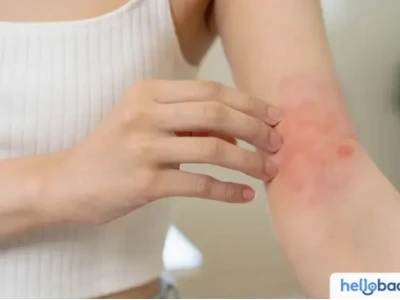 Tìm hiểu về sữa tắm trị rôm sảy cho người lớn hiệu quả