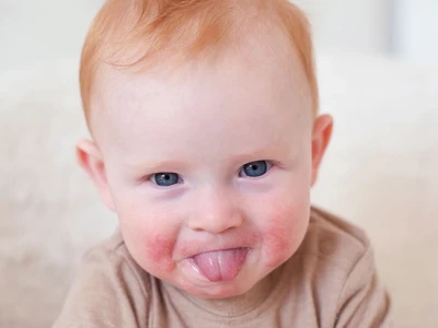 Trẻ bị nổi mẩn đỏ khắp người không sốt: Nguyên nhân và cách xử lý hiệu quả