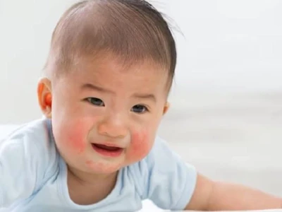 Trẻ bị nổi mụn nước khắp người: Nguyên nhân và cách xử lý hiệu quả