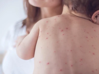 Trẻ Bị Sốt Và Ngứa Khắp Người: Nguyên Nhân và Cách Xử Lý An Toàn