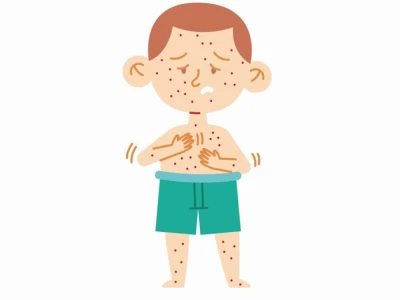 Trẻ Em Bị Nổi Mẩn Đỏ Ngứa Khắp Người: Nguyên Nhân, Cách Xử Lý Và Phòng Ngừa Hiệu Quả