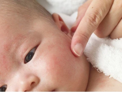 Trẻ Sơ Sinh Bị Nổi Mẩn Đỏ Khắp Người: Nguyên Nhân và Cách Xử Lý