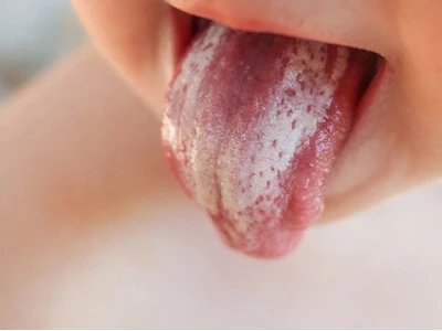 Trị nấm lưỡi ở người lớn tại nhà: Giải pháp an toàn và hiệu quả