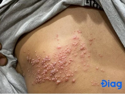 Triệu chứng nổi mụn nước ngứa khắp người: Nguyên nhân và cách xử lý hiệu quả