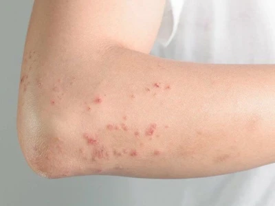 Trời Nóng Bị Ngứa Khắp Người: Nguyên Nhân Và Cách Xử Lý Hiệu Quả
