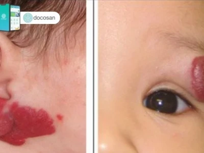 U Máu Dưới Da Ở Người Lớn: Nguyên Nhân, Triệu Chứng và Cách Xử Trí Đúng Đắn