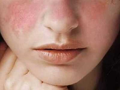 Viêm da cơ địa ở người lớn: Nguyên nhân, dấu hiệu và cách điều trị hiệu quả