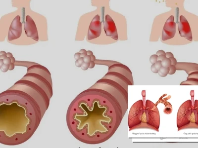 Cơ chế miễn dịch trong bệnh hen suyễn Hiểu rõ và kiểm soát