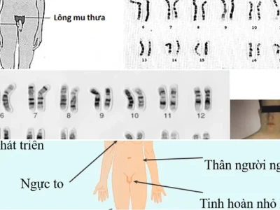 Hội chứng Turner và Klinefelter Rối loạn Nhiễm sắc thể Giới tính
