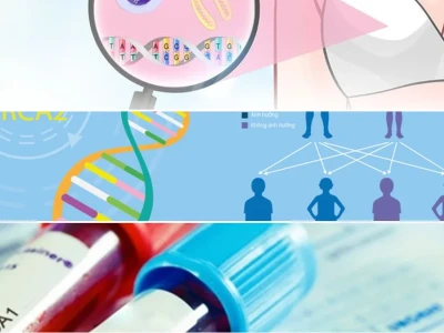 Xét Nghiệm Gen BRCA và Nguy Cơ Ung Thư Vú Di Truyền