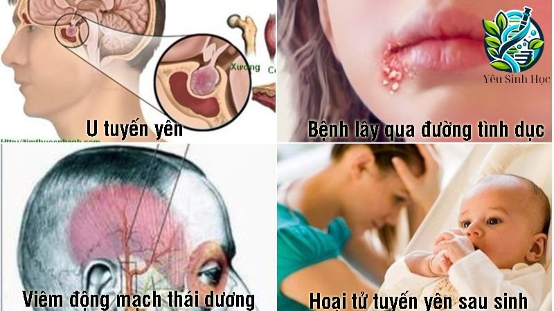 bệnh về tuyến yên