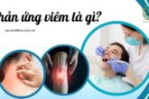 Phản ứng viêm là gì? Cơ chế và tác động đến sức khỏe con người